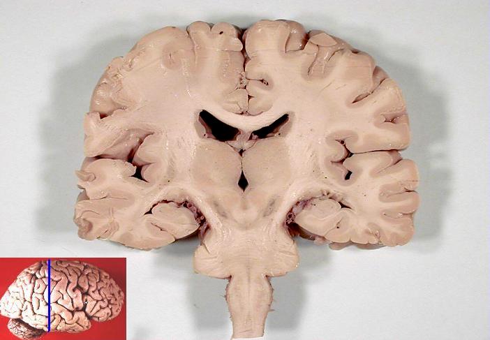 Coronal section of human brain, from John A Beal, via Wikimedia Commons